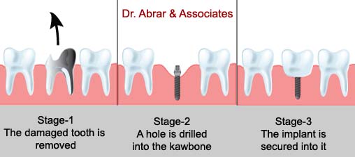 dental-implants-procedure-image
